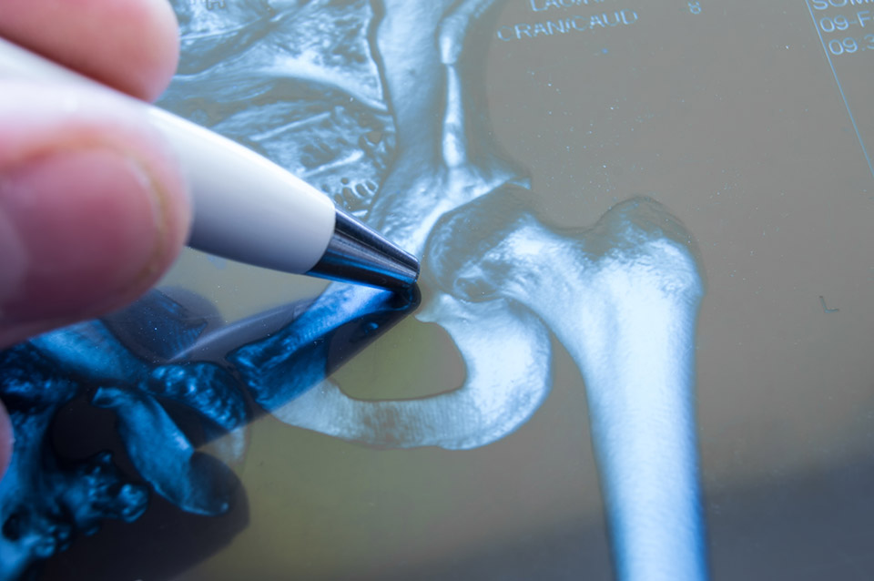 Someone pointing to an x-Ray of a hip joint with a pen.