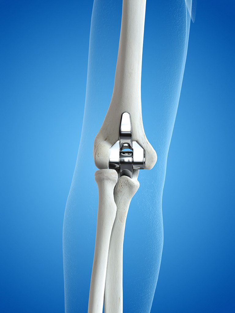 A rendering of what the artificial joint from an elbow joint replacement looks like.